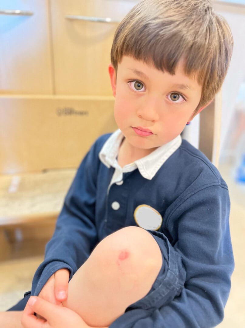 Young boy with scraped knee.